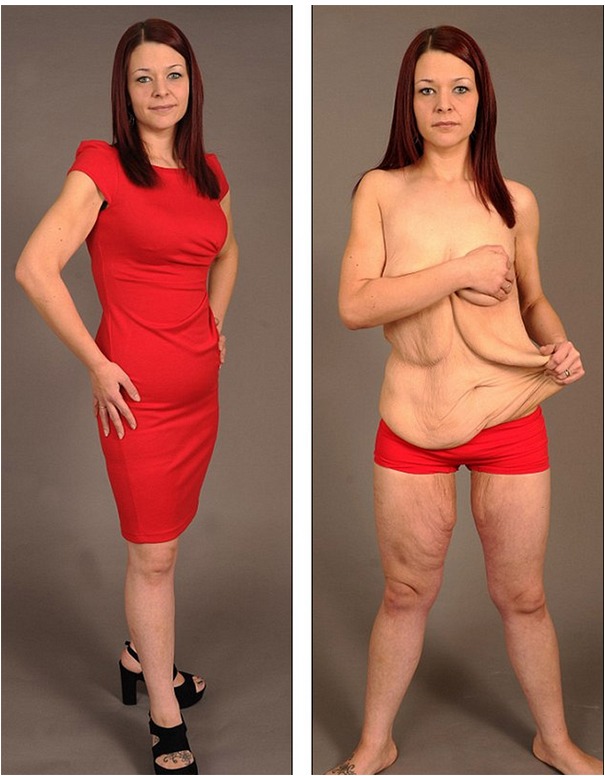 Naked before and after weightloss.